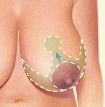 Breast Reduction