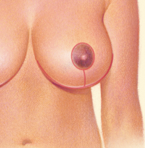 Breast Reduction