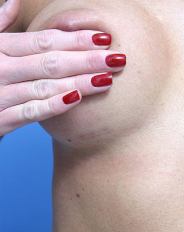 Breast Augmentation Inframammary Scar