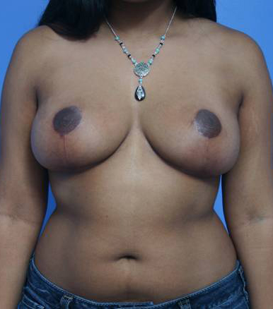 Breast Reduction After