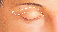 Eyelid Surgery