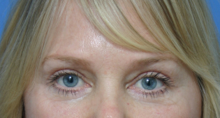 EyelidLift-After