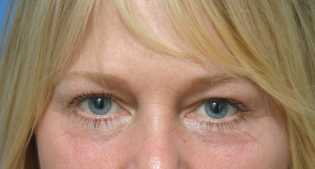 EyelidLift-Before