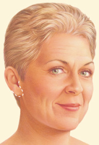 Facelift 03 205x300 1