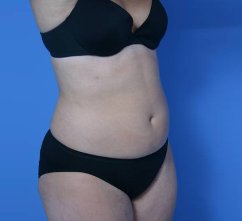 Liposuction Abdomen - After