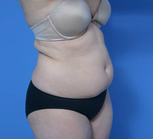 Liposuction Abdomen - Before