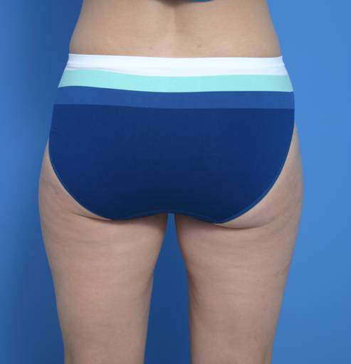 Liposuction Buttocks - After
