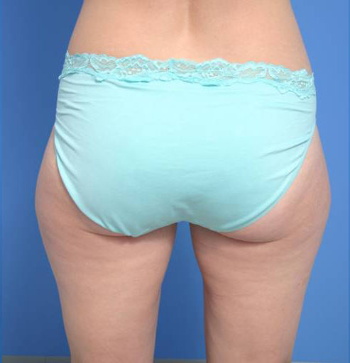 Liposuction Buttocks - Before