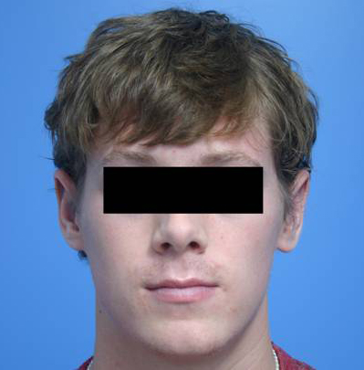 Otoplasty After