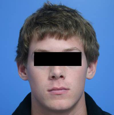 Otoplasty Before