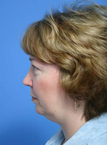 SubLiposuction-Before
