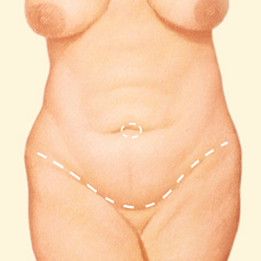 Tummy Tuck