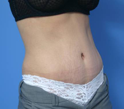 Tummy Tuck - After