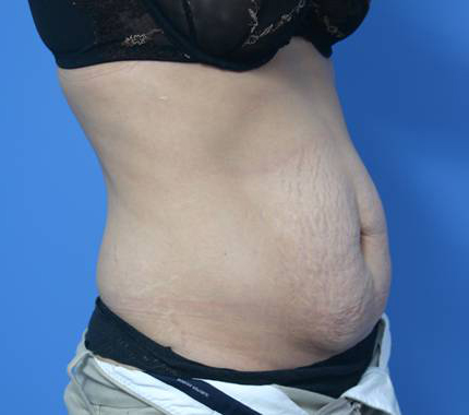 Tummy Tuck - Before