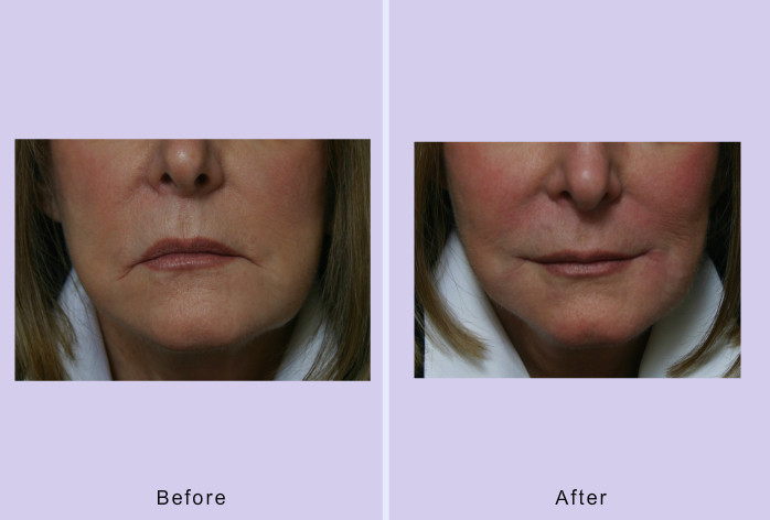 Before and After Image: grin lift – corner mouthlift – case 3 - front