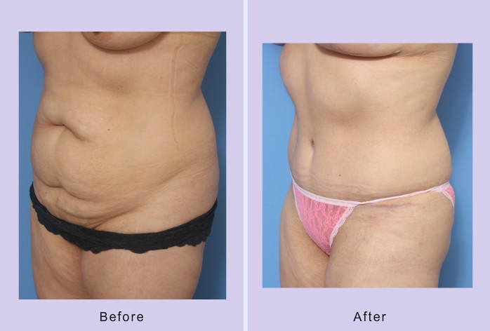 Before and After Image: abdominoplasty – tummy tuck – Case 33 - left-front-oblique