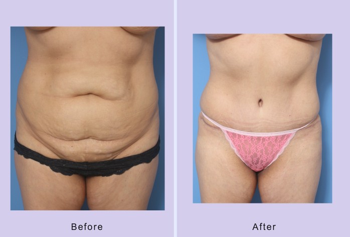 Before and After Image: abdominoplasty – tummy tuck – Case 33 - front