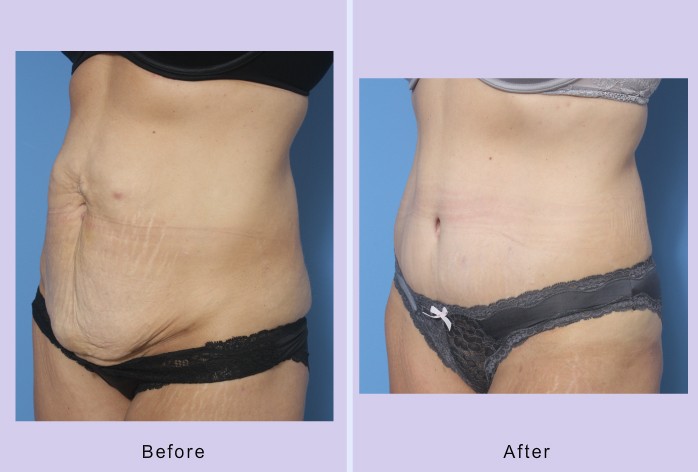 Before and After Image: abdominoplasty – tummy tuck – Case 32 - left-front-oblique
