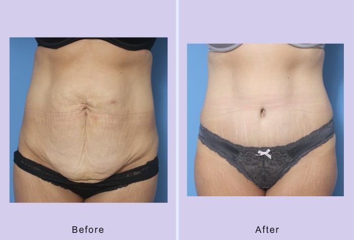 Before and After Image: abdominoplasty – tummy tuck – Case 32 - front