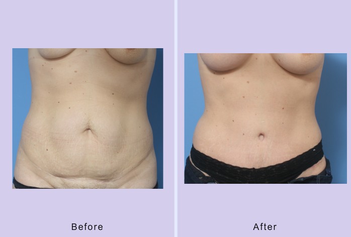 Before and After Image: abdominoplasty / tummy tuck – case 31 - front