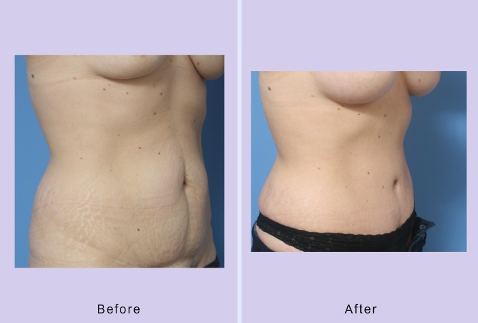 Before and After Image: abdominoplasty / tummy tuck – case 31 - right-front-oblique