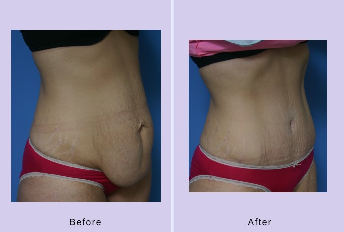 Before and After Image: abdominoplasty – tummy tuck – case 30 - right-front-oblique