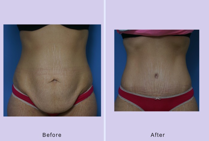 Before and After Image: abdominoplasty – tummy tuck – case 30 - front