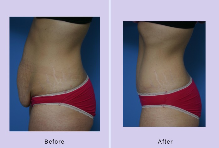 Before and After Image: abdominoplasty – tummy tuck – case 30 - left-side