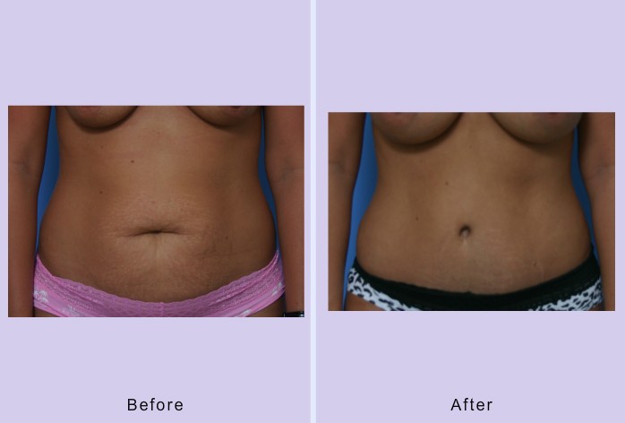 Before and After Image: abdominoplasty – tummy tuck – case 29 - front