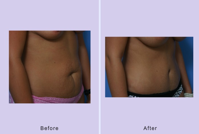 Before and After Image: abdominoplasty – tummy tuck – case 29 - right-front-oblique