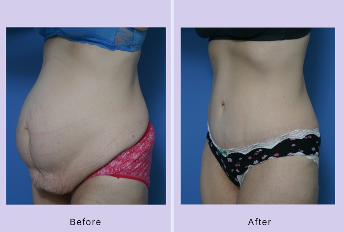 Before and After Image: abdominoplasty – tummy tuck – Case 28 - left-front-oblique