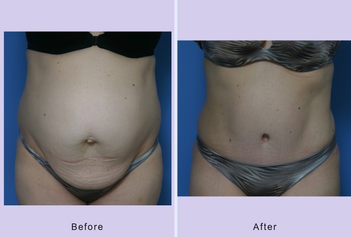 Before and After Image: abdominoplasty – tummy tuck – Case 27 - front