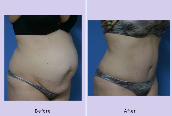 Before and After Image: abdominoplasty – tummy tuck – Case 27 - right-front-oblique