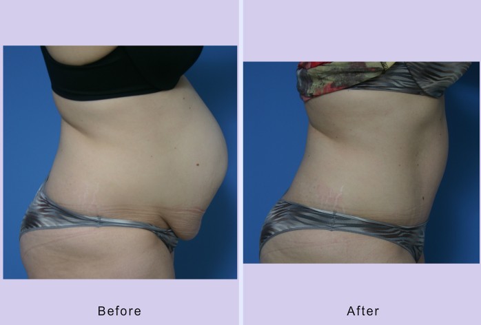 Before and After Image: abdominoplasty – tummy tuck – Case 27 - right-side