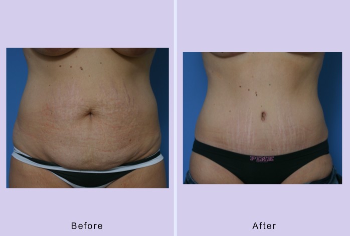 Before and After Image: abdominoplasty – tummy tuck – Case 24 - front