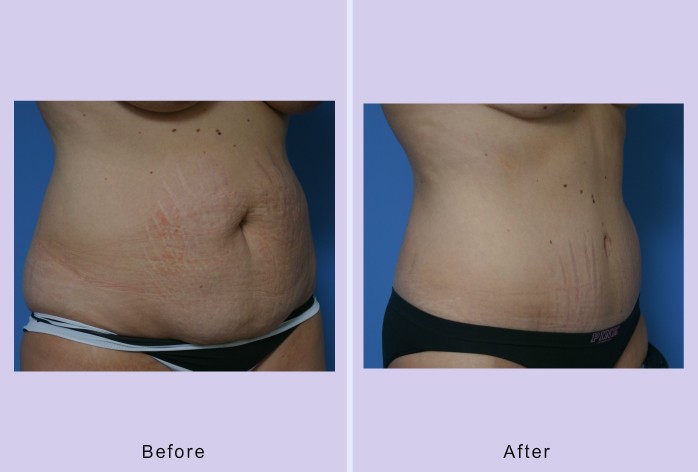 Before and After Image: abdominoplasty – tummy tuck – Case 24 - right-front-oblique