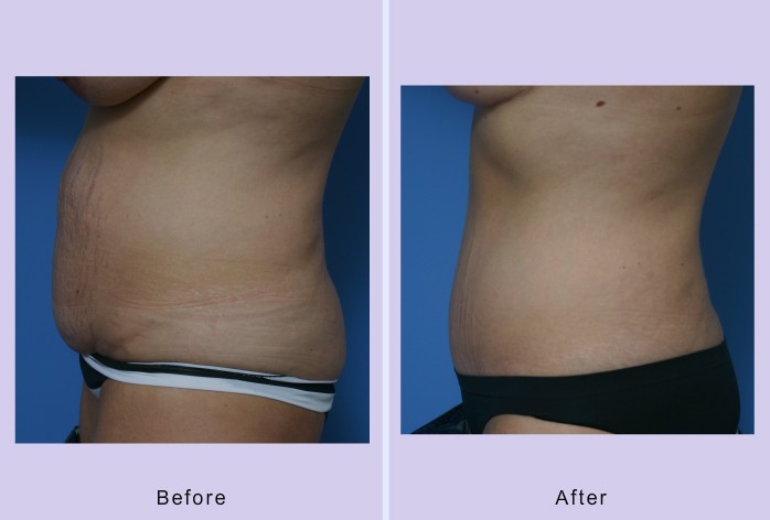 Before and After Image: abdominoplasty – tummy tuck – Case 24 - left-side