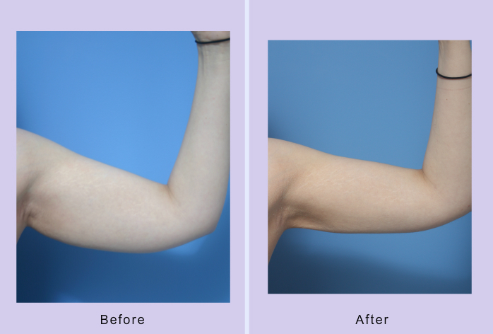 Before and After Image: liposuction – case 16 - right-side
