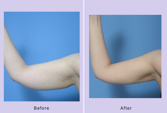 Before and After Image: liposuction – case 16 - left-side