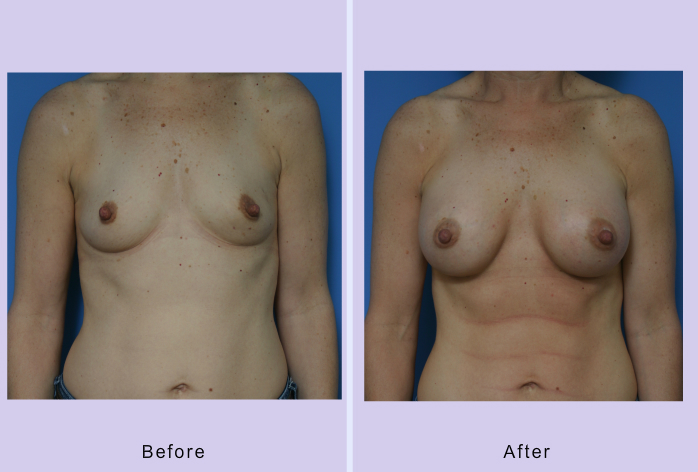 Before and After Image: breast augmentation – Case 29 - front