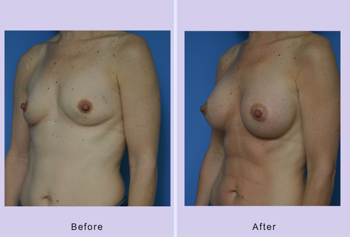 Before and After Image: breast augmentation – Case 29 - left-front-oblique