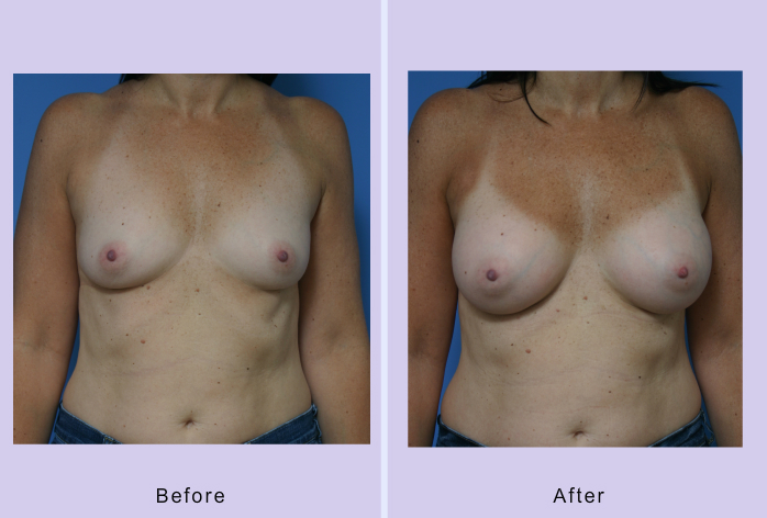 Before and After Image: breast augmentation – Case 30 - front