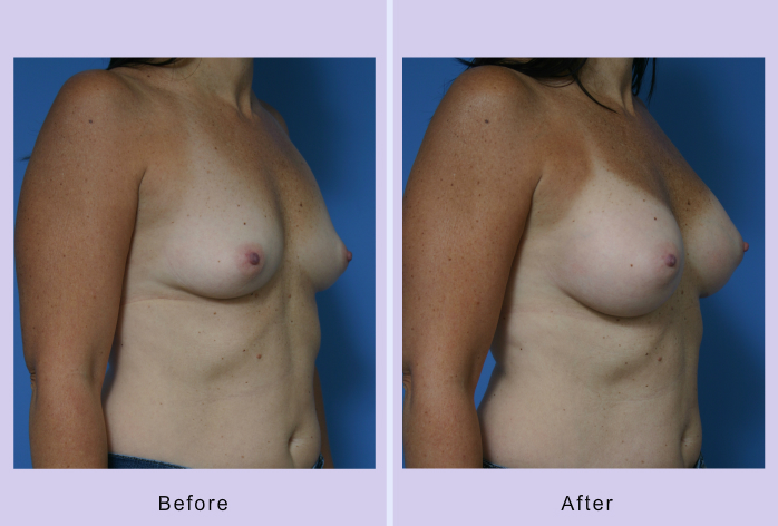 Before and After Image: breast augmentation – Case 30 - right-front-oblique