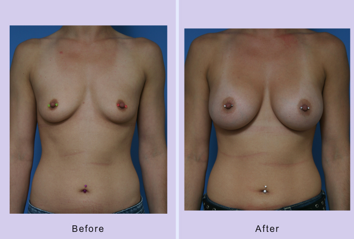 Before and After Image: breast augmentation – Case 31 - front