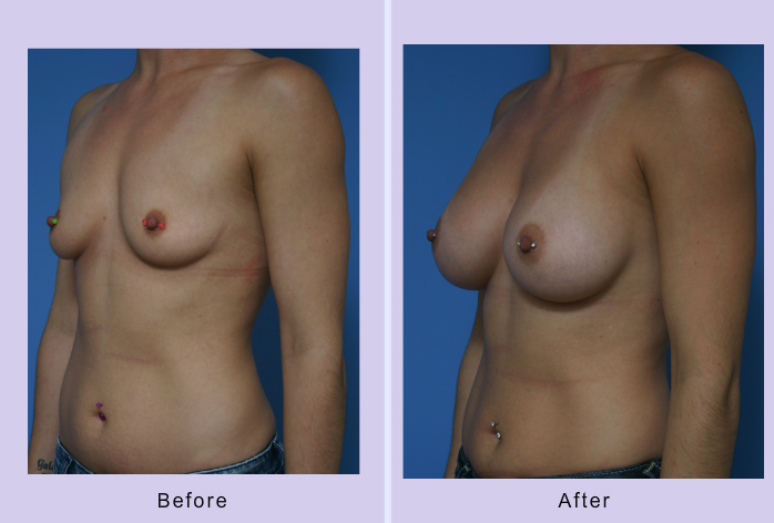 Before and After Image: breast augmentation – Case 31 - left-front-oblique