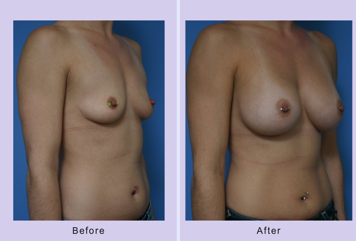 Before and After Image: breast augmentation – Case 31 - right-front-oblique