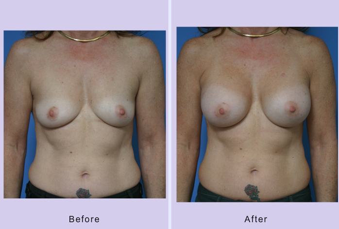 Before and After Image: breast augmentation – Case 32 - front