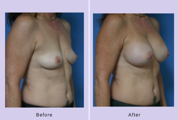 Before and After Image: breast augmentation – Case 32 - right-front-oblique