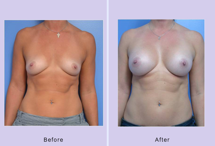 Before and After Image: breast augmentation – Case 33 - front