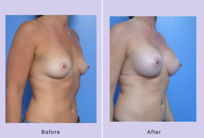 Before and After Image: breast augmentation – Case 33 - right-front-oblique
